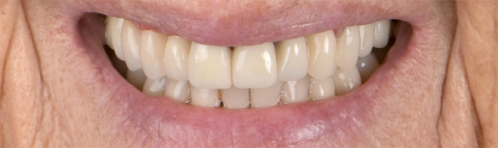 Saint Clair Dentaire - Réhabilitation globale