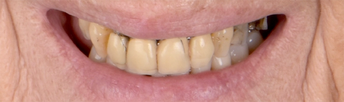 Saint Clair Dentaire - Réhabilitation globale