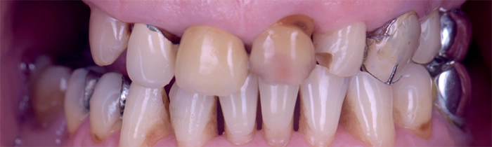 Saint Clair Dentaire - Réhabilitation globale