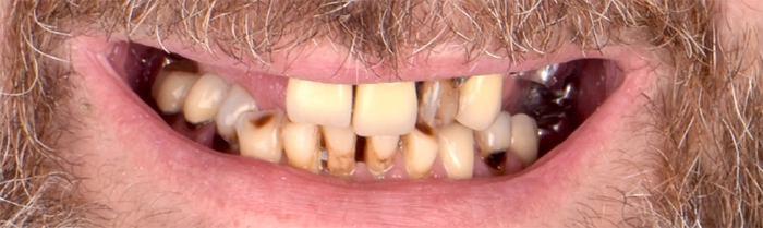 Saint Clair Dentaire - Réhabilitation globale