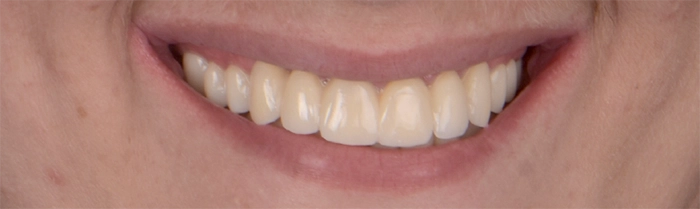 Saint Clair Dentaire – Implants