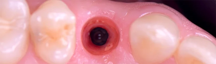 Saint Clair Dentaire – Implants