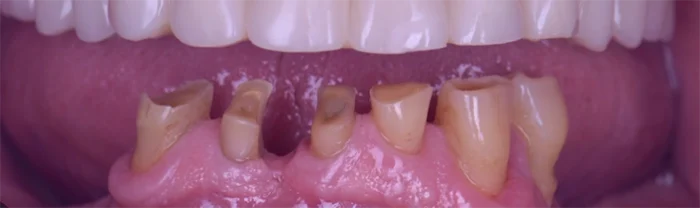 Saint Clair Dentaire – Implants