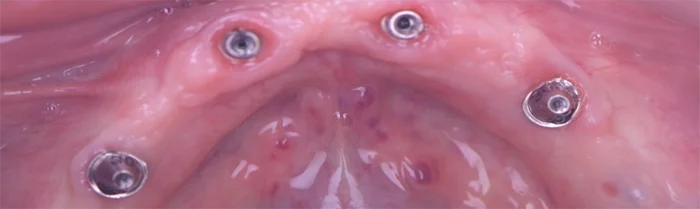 Saint Clair Dentaire – Implants