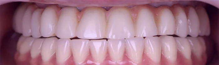 Saint Clair Dentaire – Implants