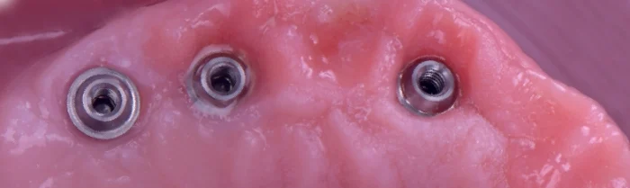 implant-slide-08